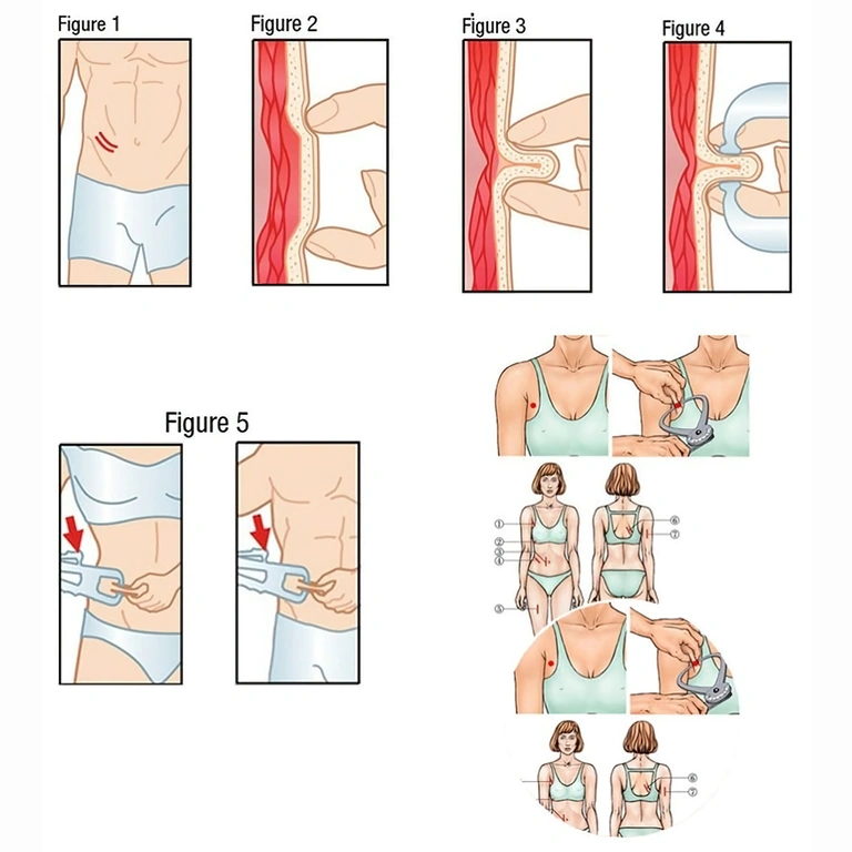 Anleitung zur Nutzung des Calipers zur Hautfaltenmessung